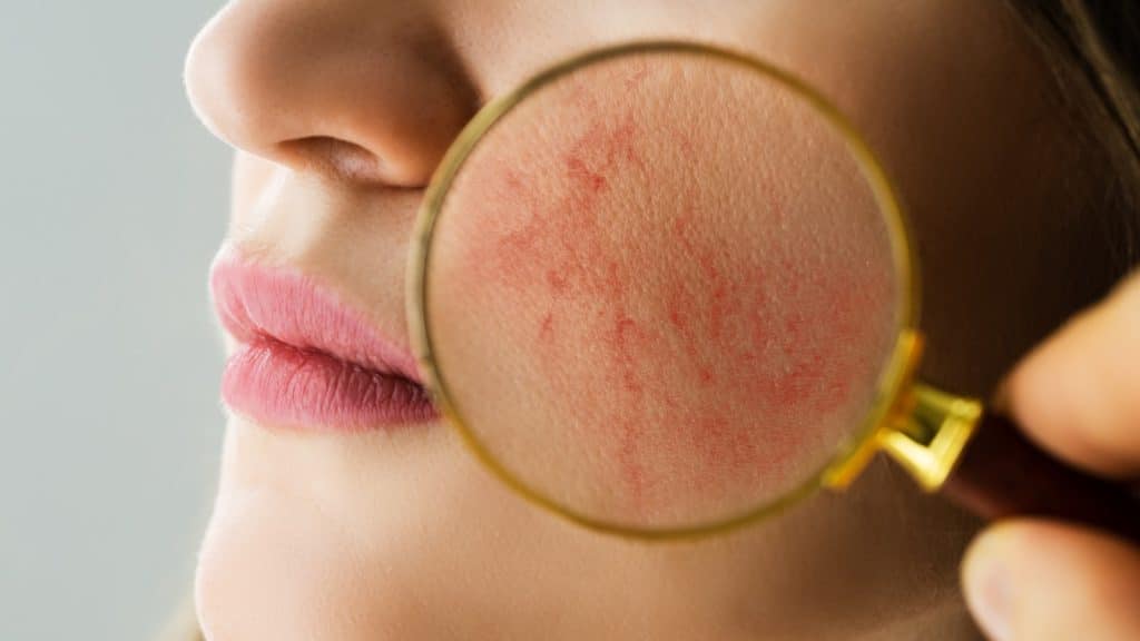 Visita nuestro blog en Farmacias Roma de Alergias de primavera en la piel.